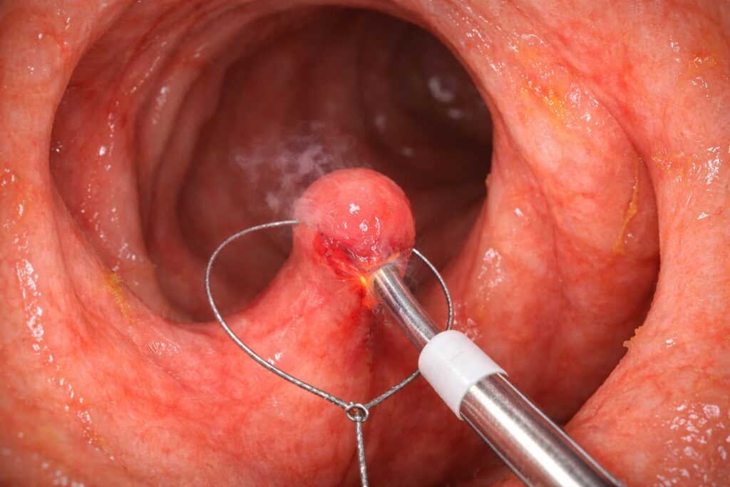 Thermal ablation procedure targeting a growth in the gastrointestinal tract, with steam visible during treatment.